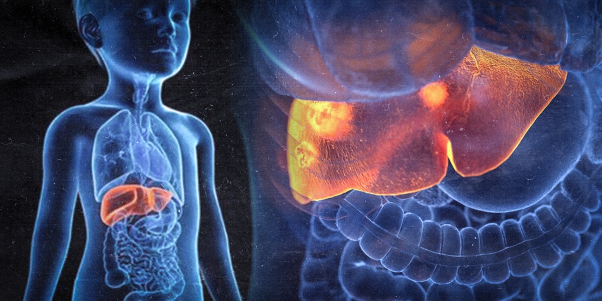 La peligrosa Qué es hepatitis aguda infantil cómo se contagia cuáles son los síntomas nueva hepatitis recomendaciones para niños cuidados enfermedades 